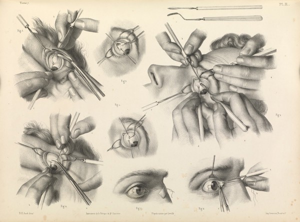 Traité complet de l'anatomie de l'homme comprenant la médecine opératoire ... : avec planches lithographiées ... / par N.H. Jacob.