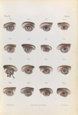 view Plate 8. Illustration of various eye diseases