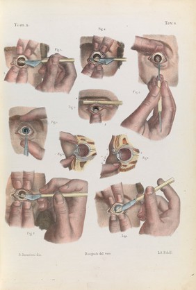 Iconografia d'anatomia chirurgica e di medicina operatoria / [Jean Baptiste Marc Bourgery].