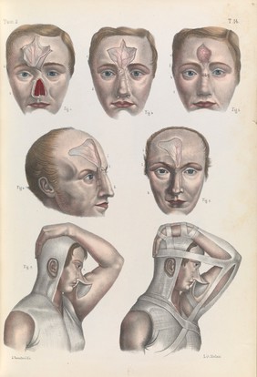 Iconografia d'anatomia chirurgica e di medicina operatoria / [Jean Baptiste Marc Bourgery].