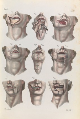 Iconografia d'anatomia chirurgica e di medicina operatoria / [Jean Baptiste Marc Bourgery].