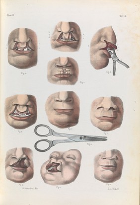 Iconografia d'anatomia chirurgica e di medicina operatoria / [Jean Baptiste Marc Bourgery].