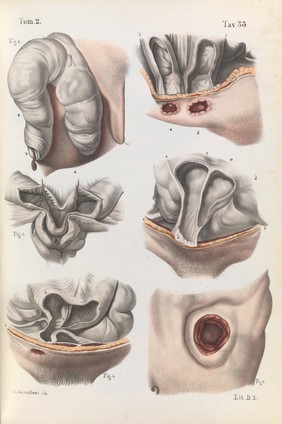 Iconografia d'anatomia chirurgica e di medicina operatoria / [Jean Baptiste Marc Bourgery].