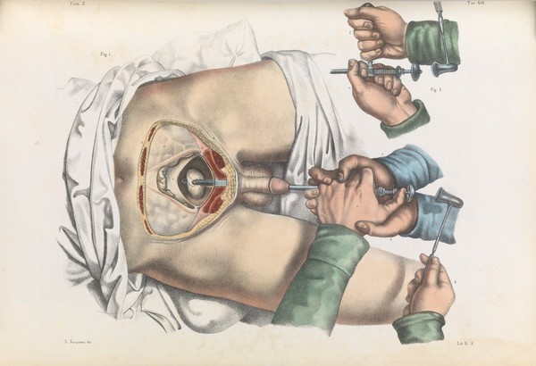 Iconografia d'anatomia chirurgica e di medicina operatoria / [Jean Baptiste Marc Bourgery].