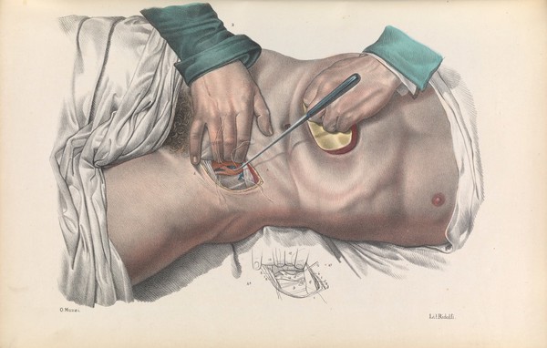 Iconografia d'anatomia chirurgica e di medicina operatoria / [Jean Baptiste Marc Bourgery].