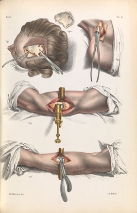 Iconografia d'anatomia chirurgica e di medicina operatoria / [Jean Baptiste Marc Bourgery].