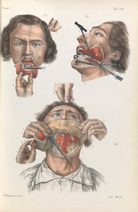 Iconografia d'anatomia chirurgica e di medicina operatoria / [Jean Baptiste Marc Bourgery].