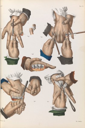 Iconografia d'anatomia chirurgica e di medicina operatoria / [Jean Baptiste Marc Bourgery].