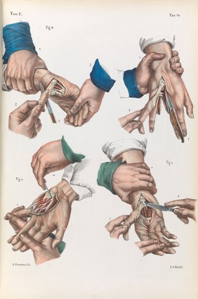 Iconografia d'anatomia chirurgica e di medicina operatoria / [Jean Baptiste Marc Bourgery].