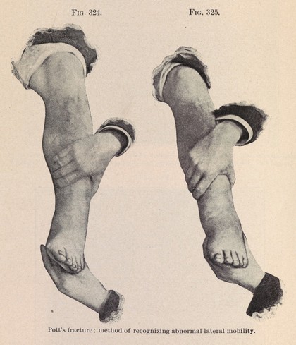 A practical treatise on fractures and dislocations / by Lewis A. Stimson.