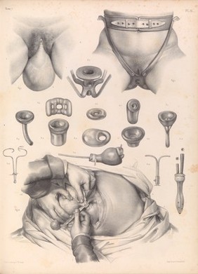 Traité complet de l'anatomie de l'homme comprenant la médecine opératoire ... : avec planches lithographiées ... / par N.H. Jacob.