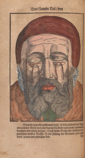 Ophthalmodouleia. Das ist Augendienst. Newer vnd wolgegründter Bericht von Ursachen vnd Erkentnüs aller Gebrechen, Schäden vnd Mängel der Augen vnd des Gesichtes, wie man solchen anfenglich mit gebürlichen mitteln begegenen, vorkommen vnd wehren, auch wie man alle solche gebresten künstlich durch Artzney, Instrument vnd Handgrieffe curiren, wircken vnd vertreiben sol ... / Durch George Bartisch.