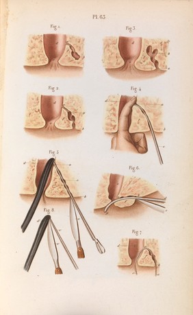 Précis iconographique de médecine opératoire et d'anatomie chirurgicale / [Claude Bernard].