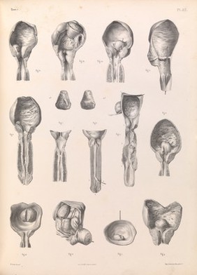 Plate 53. Pathology of the male genitalia, urinary organs.