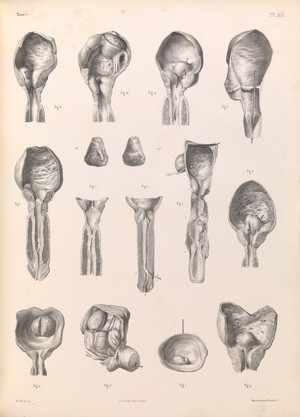 view Plate 53. Pathology of the male genitalia, urinary organs.