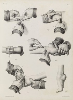 Plate H. Surgical technique to correct club foot.