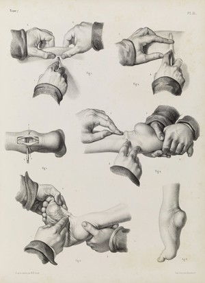 view Plate H. Surgical technique to correct club foot.