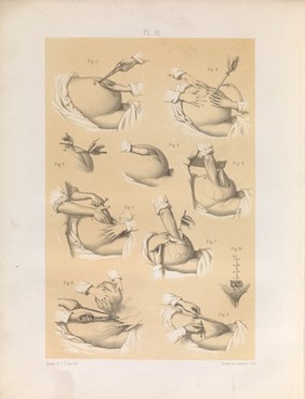 Plate 16. Removal of a tumour from the uterus.