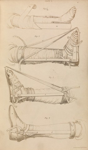 Operation for the cure of clubfoot / illustrated by explanatory plates, the drawings after nature: being an appendix to a System of practical surgery.