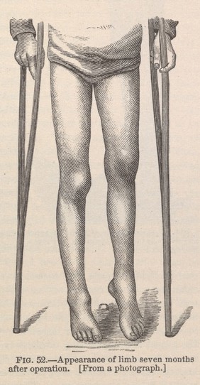 The medical and surgical history of the war of the rebellion, (1861-65) / Prepared, in accordance with the acts of Congress, under the direction of Surgeon General, Joseph K. Barnes, United States Army.
