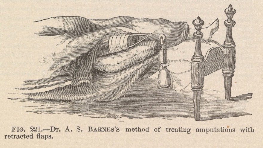 The medical and surgical history of the war of the rebellion, (1861-65) / Prepared, in accordance with the acts of Congress, under the direction of Surgeon General, Joseph K. Barnes, United States Army.