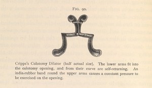 view Fig. 90. Cripps Colotomy Dilator