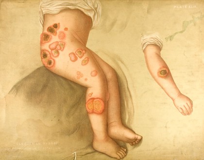 Areas of diseased skin on the scalp of a child affected by kerion from ringworm. Chromolithograph by E. Burgess, 1850/1880?.