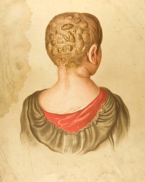 Diseased skin on scalp and neck of a girl suffering from porrigo contagiosa. Chromolithograph by E. Burgess, 1850/1880?.