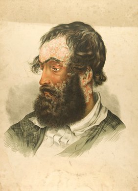 Diseased skin on the face, neck and ear of a man suffering from psoriasis. Chromolithograph by E. Burgess (?), 1850/1880?.