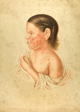 Diseased skin on the face, neck and chest of a girl suffering from lupus psoriasis and body of a man suffering from molluscum simplex. Chromolithograph by E. Burgess, 1850/1880?.