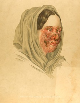 Diseased skin on the face of a woman suffering from lupus vulgaris. Chromolithograph by E. Burgess (?), 1850/1880?.