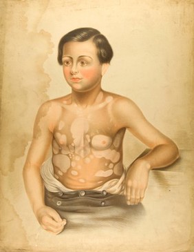 Discoloured areas of skin on the torso of a boy suffering from leucoderma (vitiligo). Chromolithograph by E. Burgess, 1850/1880?.