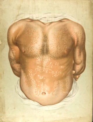 Discoloured skin on the torso and arms of a man suffering from pityriasis versicolor. Chromolithograph by E. Burgess, 1850/1880?.