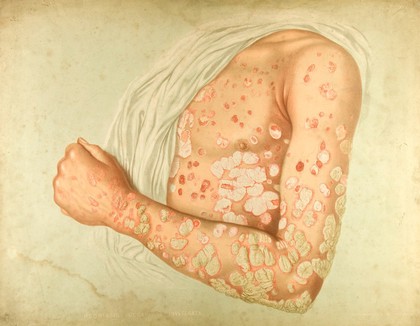 Diseased skin on the chest and arm of a man suffering from psoriasis. Chromolithograph by E. Burgess, 1850/1880?.