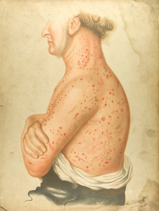 Diseased skin on the torso, neck and arms of a man suffering from morbus pedicularis. Chromolithograph by E. Burgess, 1850/1880?.