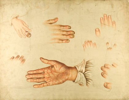 Diseased skin and nails on the hands and fingers of sufferers of a variety of diseases, including psoriasis and syphilis. Chromolithograph by E. Burgess, 1850/1880?.