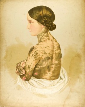 Diseased skin on the neck, back, arms and hands of a young woman suffering from icthyosis hystrix. Chromolithograph by E. Burgess (?), 1850/1880?.