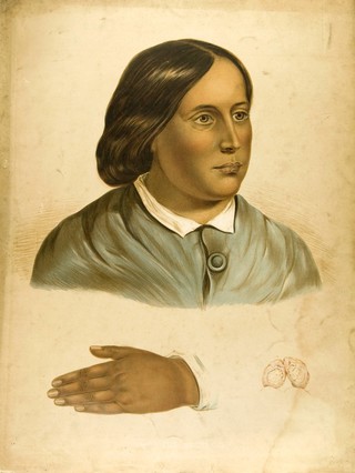 Face and hand of a woman suffering from morbus addisonii (bronzed skin disease), with a detail showing an unidentified organ (?). Chromolithograph after W. Hurst, 1850/1880?.