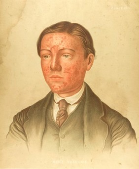Skin on the face of a young man suffering from acne vulgaris. Chromolithograph by E. Burgess, 1850/1880?.