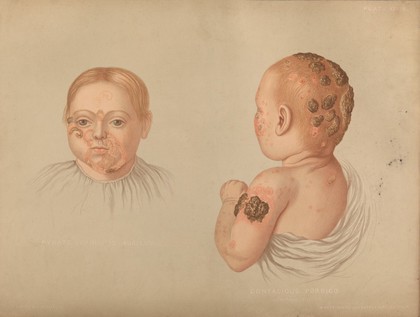 Severely diseased skin on the face, buttocks and genitals of a baby boy suffering from inherited syphilis. Chromolithograph by E. Burgess, 1850/1880?.