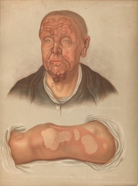 Areas of diseased skin on the scalp of a child affected by kerion from ringworm. Chromolithograph by E. Burgess, 1850/1880?.