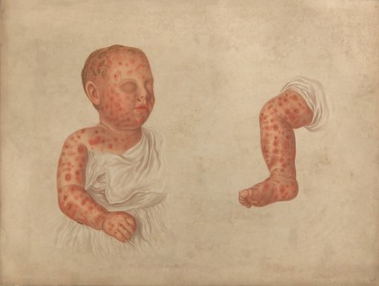 Severely diseased skin on the face, buttocks and genitals of a baby boy suffering from inherited syphilis. Chromolithograph by E. Burgess, 1850/1880?.