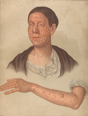 Severely diseased skin on the face, buttocks and genitals of a baby boy suffering from inherited syphilis. Chromolithograph by E. Burgess, 1850/1880?.