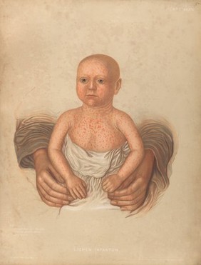 Severely diseased skin on the face, buttocks and genitals of a baby boy suffering from inherited syphilis. Chromolithograph by E. Burgess, 1850/1880?.