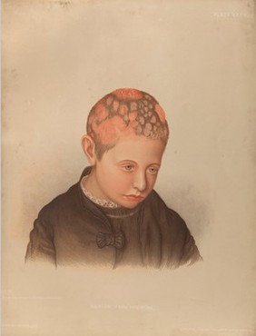 Areas of diseased skin on the scalp of a child affected by kerion from ringworm. Chromolithograph by E. Burgess, 1850/1880?.