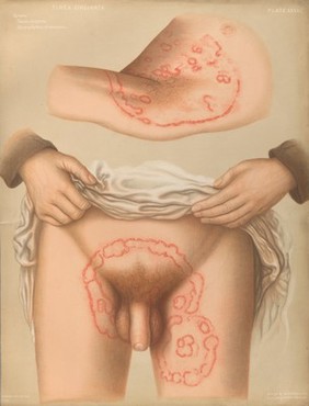 Severely diseased skin on the face, buttocks and genitals of a baby boy suffering from inherited syphilis. Chromolithograph by E. Burgess, 1850/1880?.