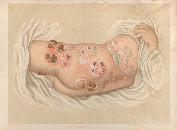 Severely diseased skin on the face, buttocks and genitals of a baby boy suffering from inherited syphilis. Chromolithograph by E. Burgess, 1850/1880?.