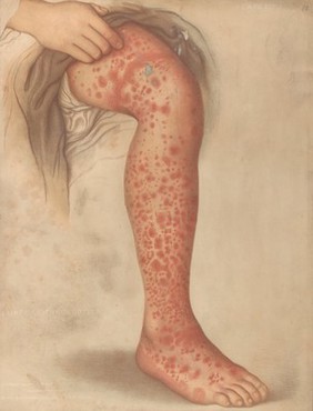 Areas of diseased skin on the scalp of a child affected by kerion from ringworm. Chromolithograph by E. Burgess, 1850/1880?.