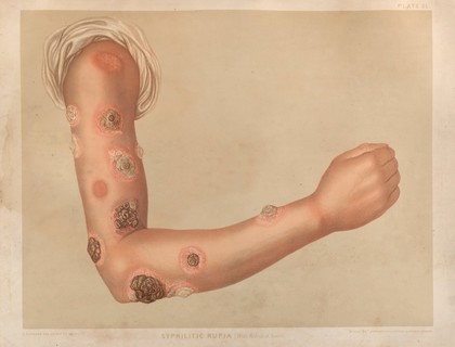 Severely diseased skin on the face, buttocks and genitals of a baby boy suffering from inherited syphilis. Chromolithograph by E. Burgess, 1850/1880?.