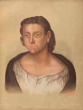 Severely diseased skin on the face, buttocks and genitals of a baby boy suffering from inherited syphilis. Chromolithograph by E. Burgess, 1850/1880?.